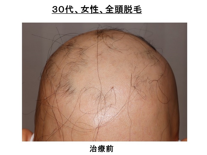 円形脱毛症　病院